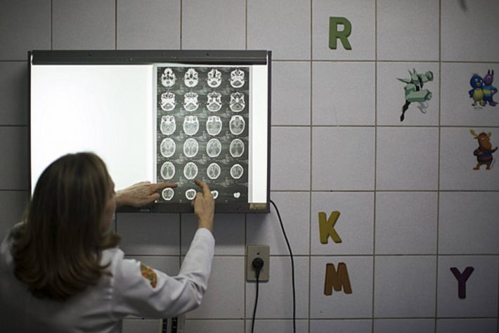 Médica do Hospital Oswaldo Cruz, no Recife, analisa tomografia de bebê com microcefalia. Foto: Felipe Dana/AP