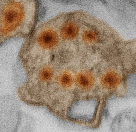 Imagem de microscopia mostra o vírus (laranja) dentro de um vesícula celular: prova da infecção. Crédito: Rodrigo Madeiro/IDOR